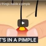 All the nasty things inside a pimple